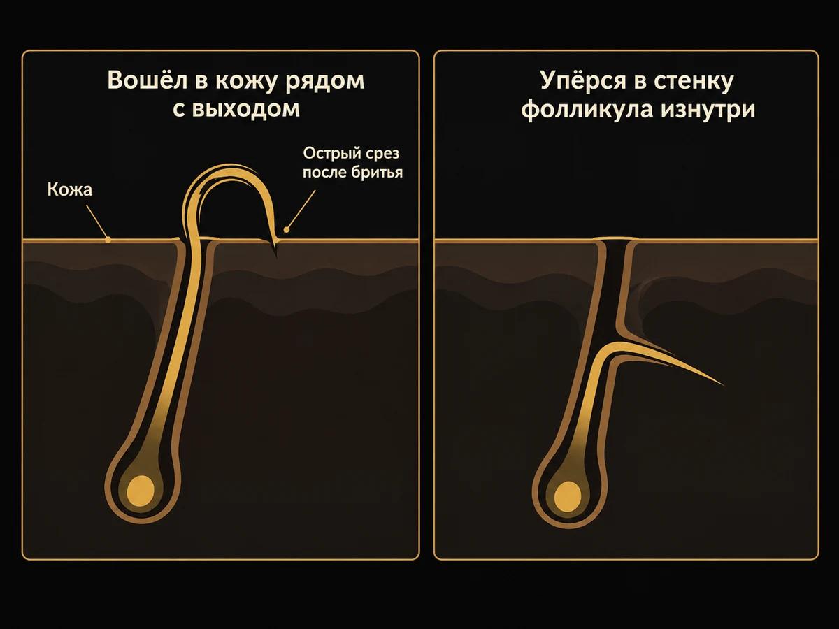 Схема двух путей врастания: сбритый завитой волос входит в кожу рядом с выходом или упирается в стенку фолликула